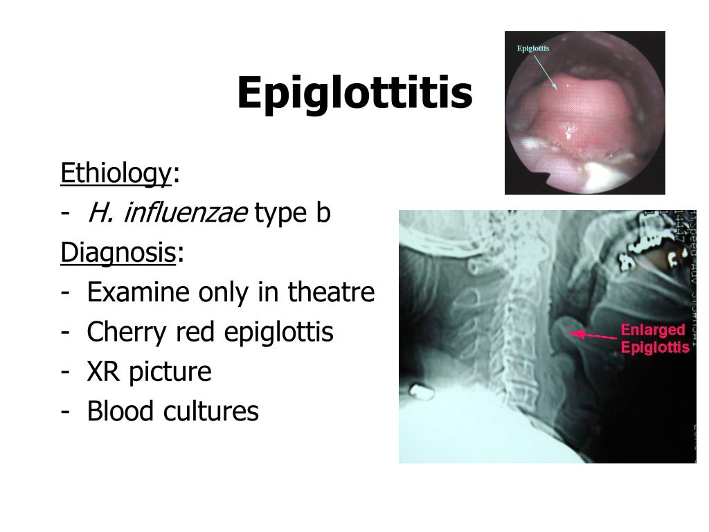 PPT - INFECTIONS OF THE UPPER RESPIRATORY TRACT PowerPoint Presentation ...