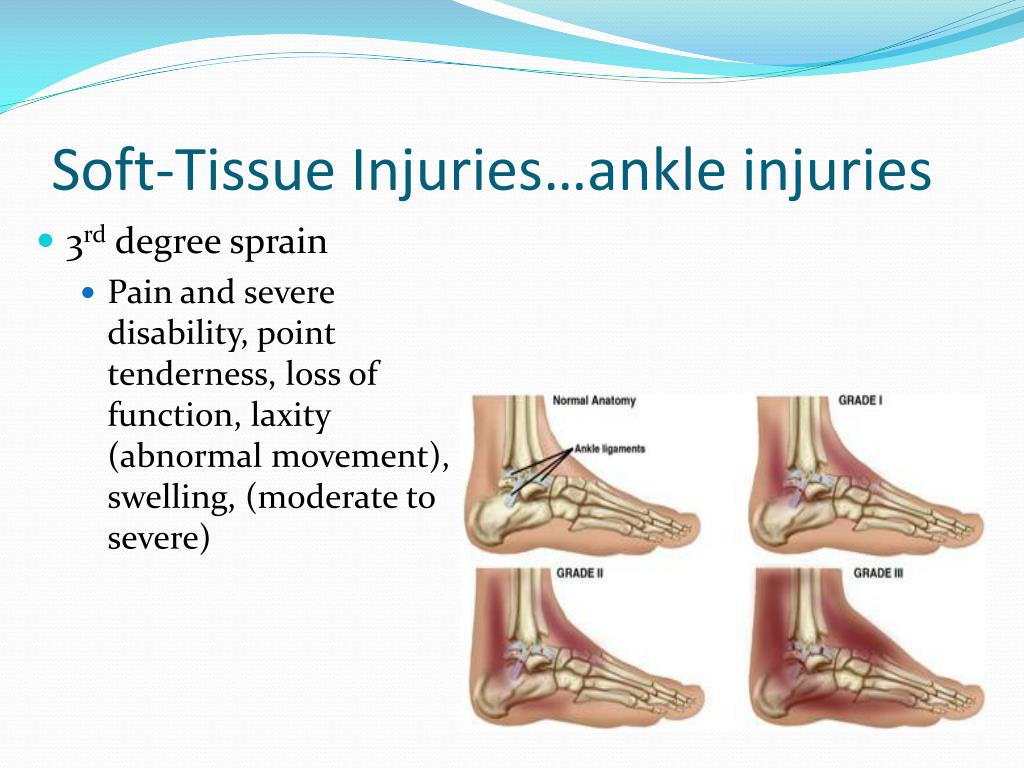 PPT - Injuries to the Lower Leg, Ankle, and Foot PowerPoint ...