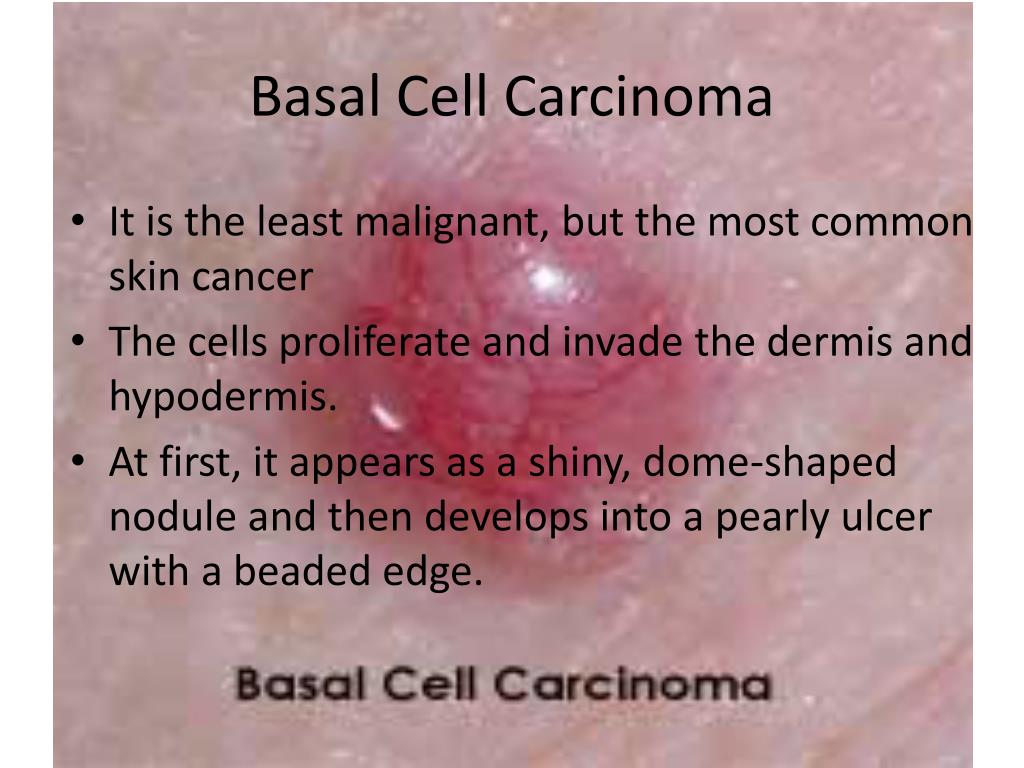 PPT Sun Exposure/Skin Cancer PowerPoint Presentation, free download