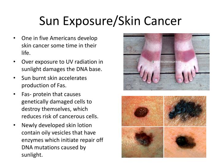 PPT - Sun Exposure/Skin Cancer PowerPoint Presentation - ID:1910524