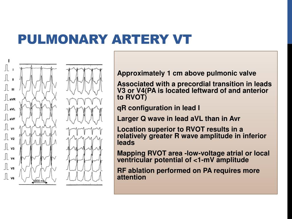 PPT - VENTRICULAR TACHYCARDIAS IN THE ABSENCE OF STRUCTURAL HEART ...