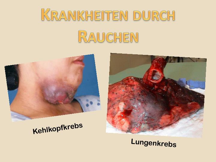 PPT - Rauchen PowerPoint Presentation - ID:1914542