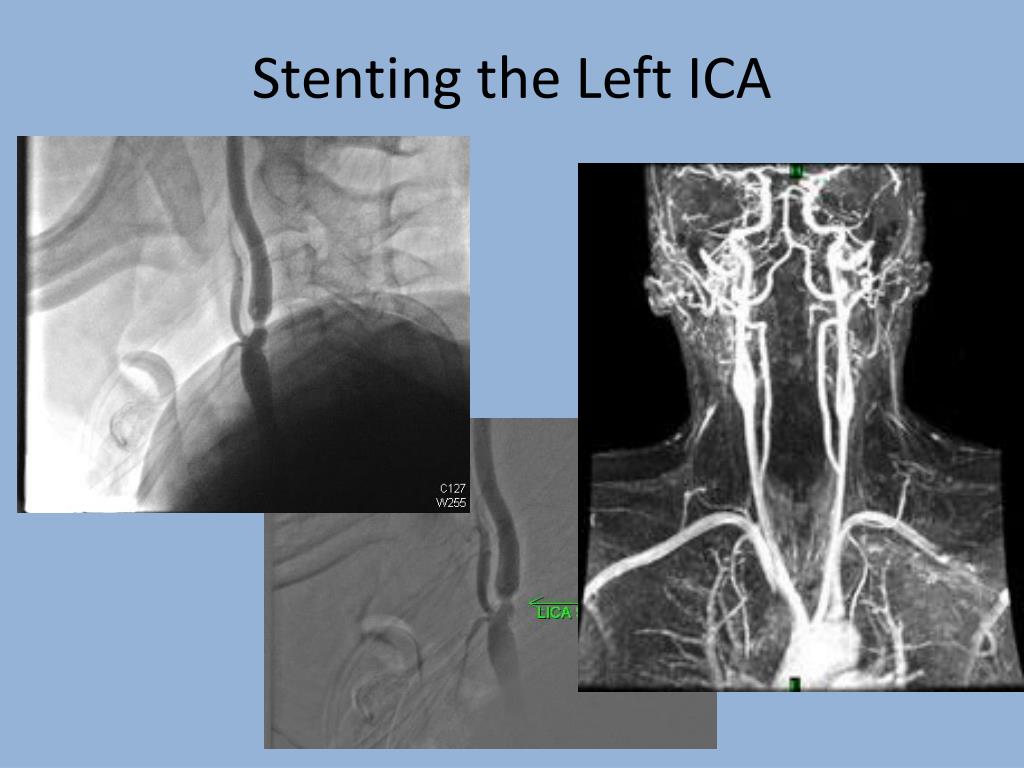 icad stroke icad stroke