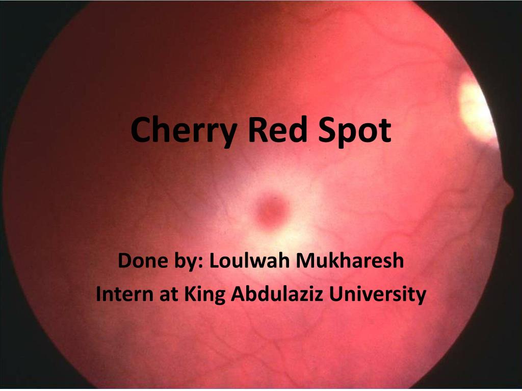 PPT - Cherry Red Spot PowerPoint Presentation, free download - ID:1917389