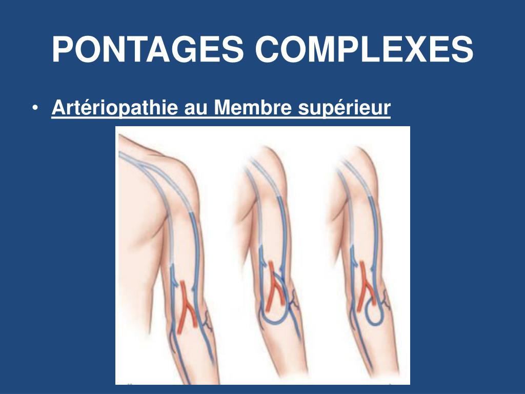 PPT HÉMODIALYSE PONTAGES AUX MEMBRES SUPÉRIEURS PowerPoint — free download
