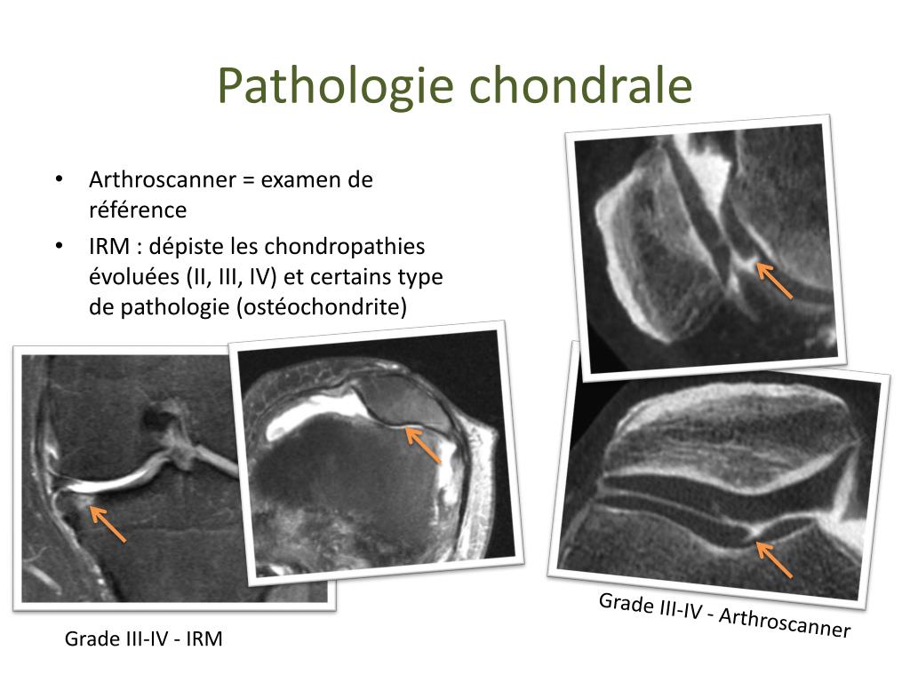 PPT Imagerie du genou pour le rhumatologue PowerPoint Presentation — free download