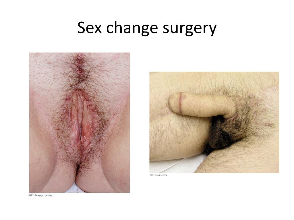 Transgender surgery