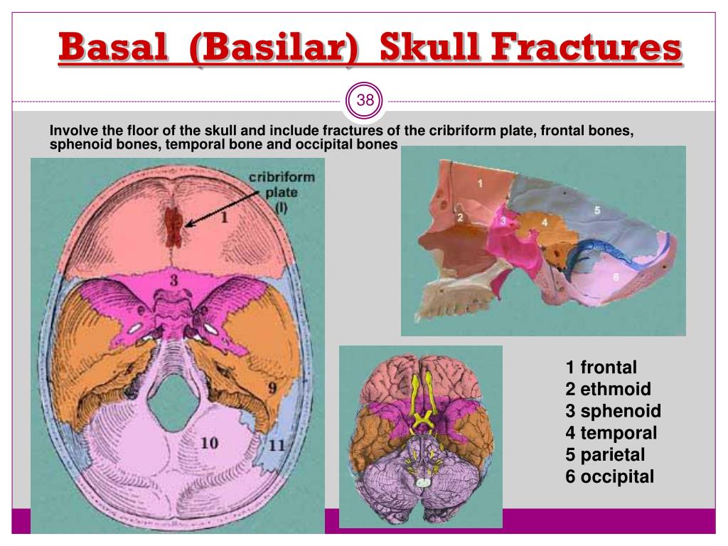 basilar fracture symptoms basilar fracture symptoms
