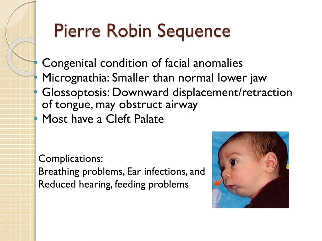 pierre robin sequence vs treacher pierre robin sequence vs treacher