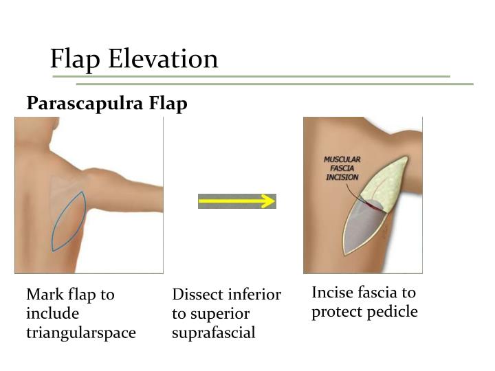 Left Parascapular PPT - Scapular, Parascapular and P ectoralis Flaps PowerPoint ...