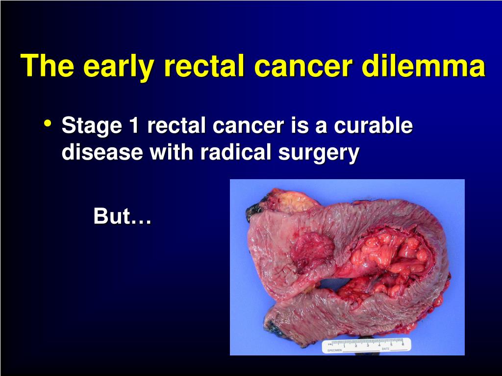 PPT - Organ Sparing Treatments for Early Rectal Cancer The ...