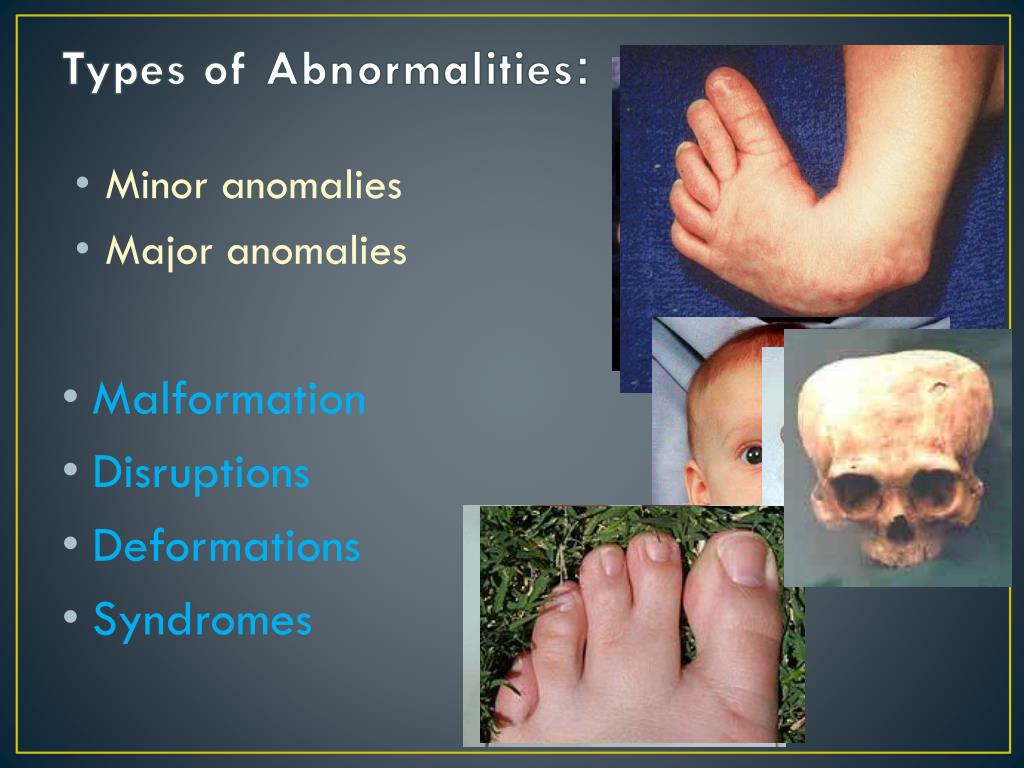 PPT - Causes of Malformations ( Teratogenesis or Dismorphology