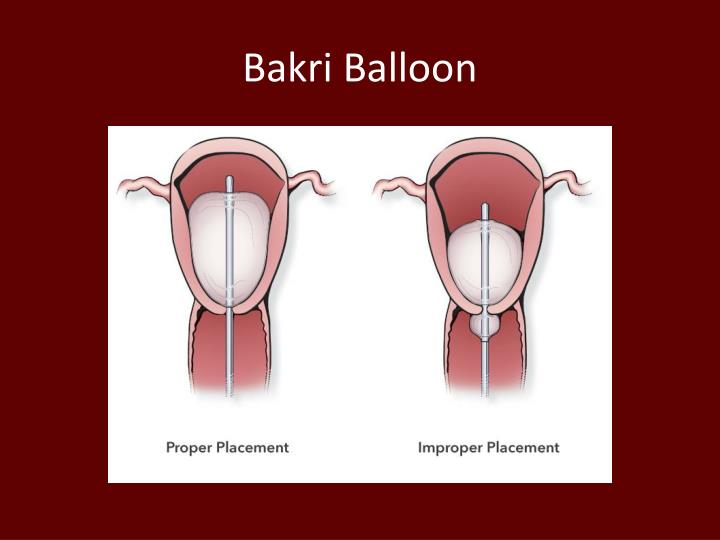 ppt obstetric hemorrhage powerpoint presentation id 1944104 bakri balloon