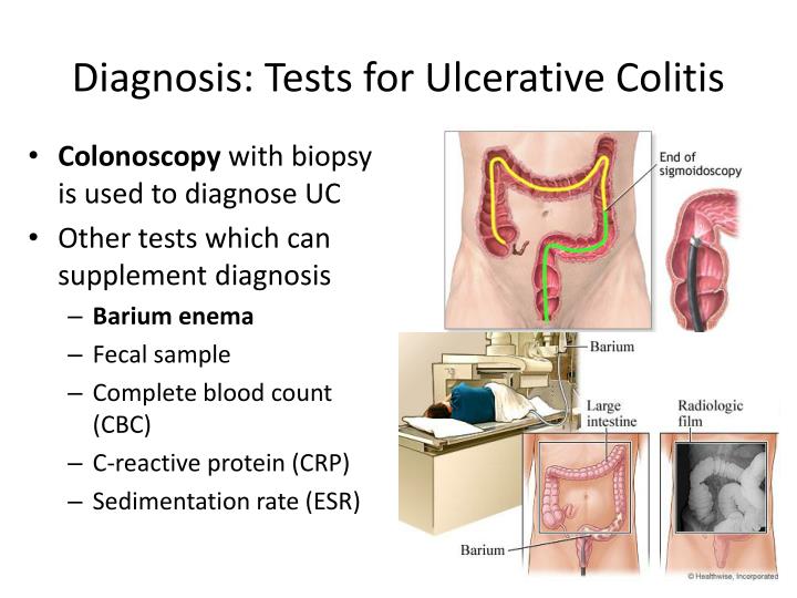 Ppt Ulcerative Colitis Powerpoint Presentation Id1945751 3301