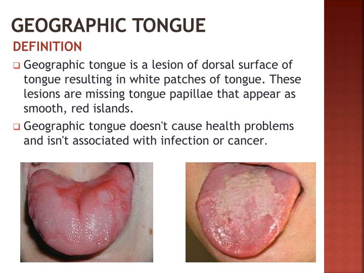 PPT - TONGUE DISORDERS PowerPoint Presentation - ID:1947046