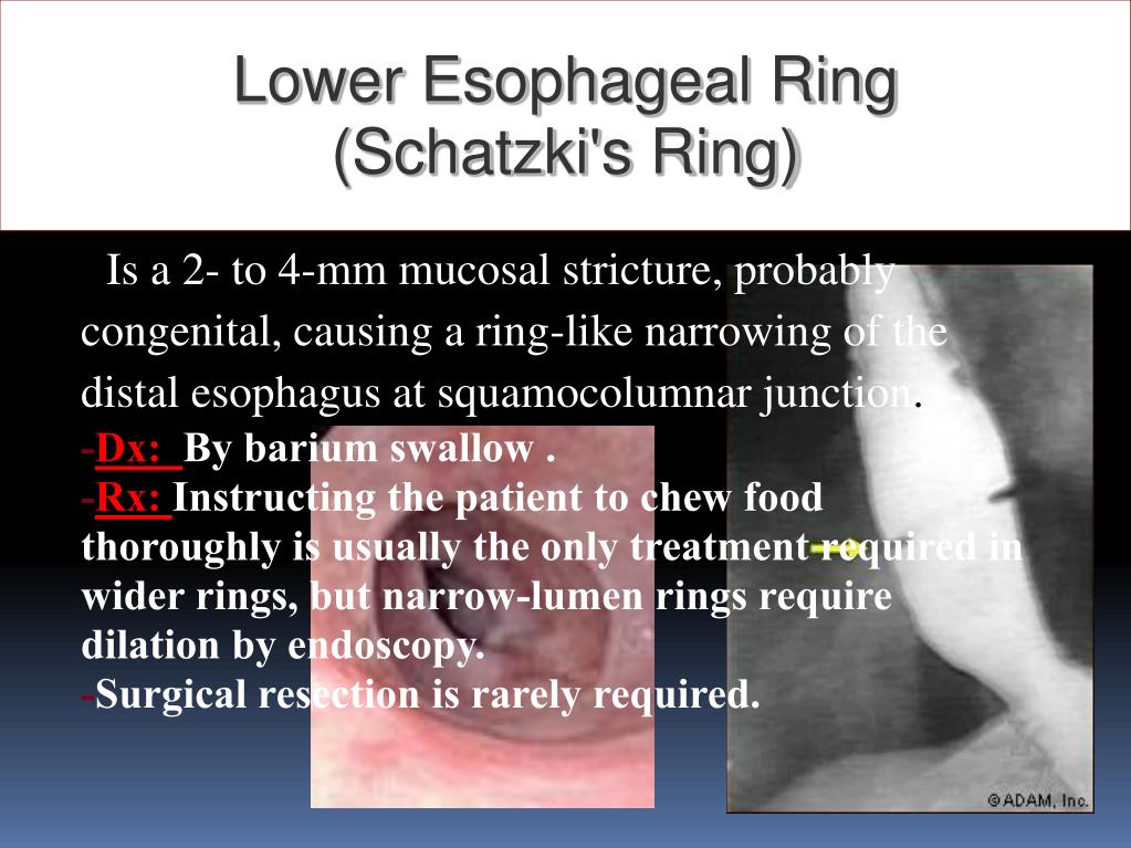 How to differentiate between sophageal stricture, webs and rings 7  radiology in GIT - YouTube