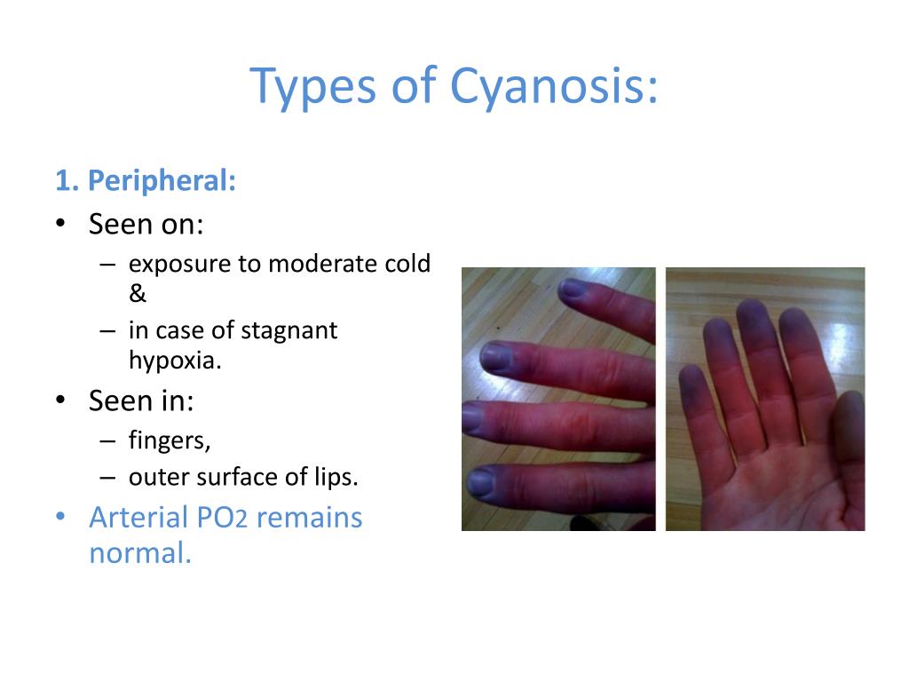 PPT - Hypoxia: types & effects, Cyanosis, Hypercapnia , Dyspnea ...