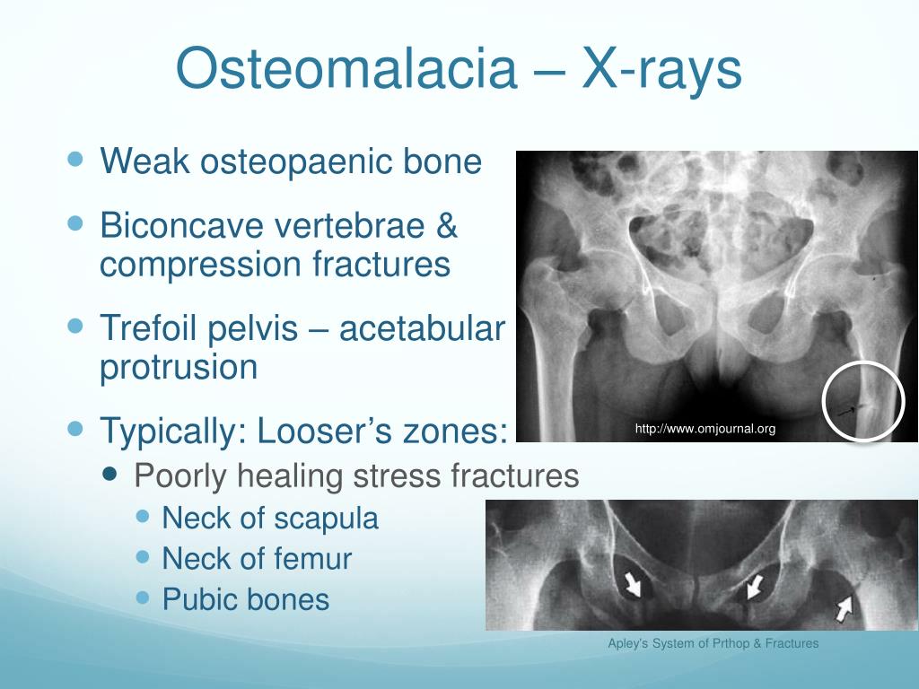 Weak osteopaenic bone * Biconcave vertebrae & compression fractures * T...