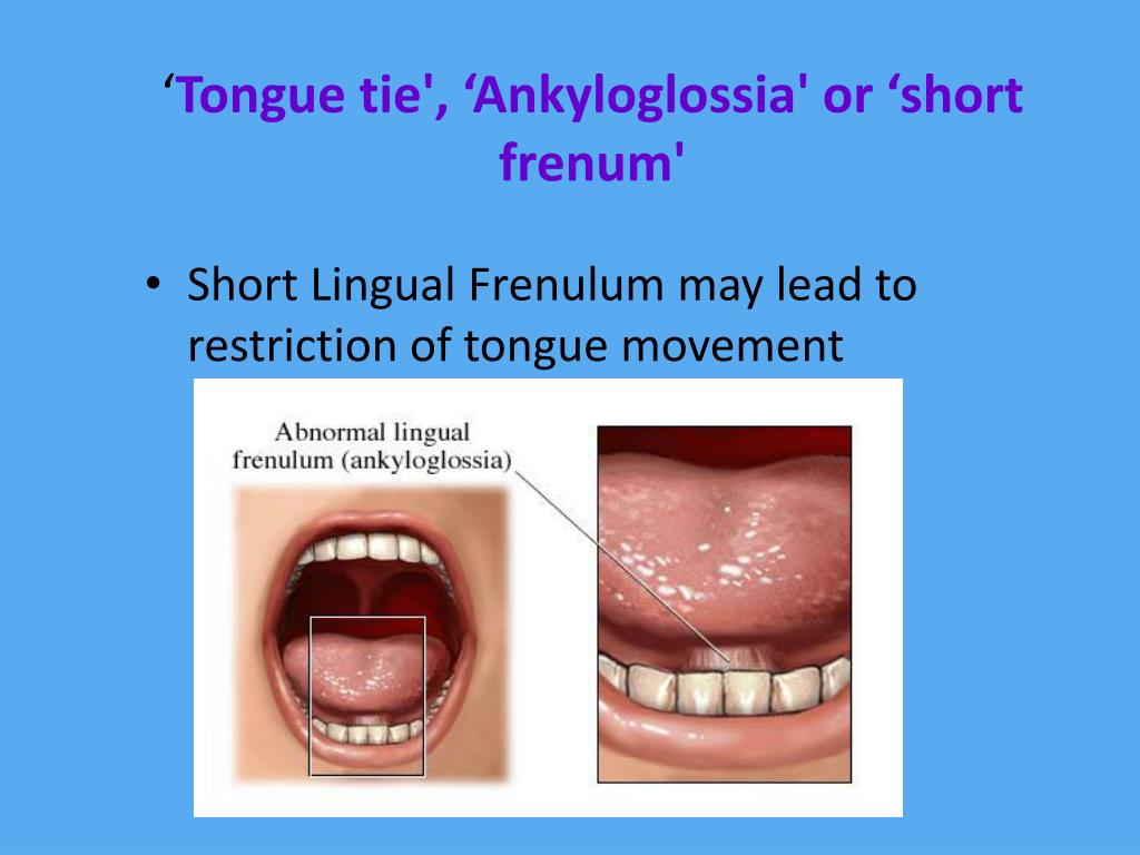 Ppt Impact On Breastfeeding Of Restrictive Lingual Frenulum Powerpoint Presentation Id1952564 