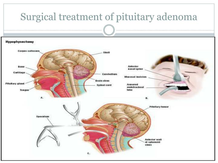 PPT - Pituitary tumors PowerPoint Presentation - ID:1954831