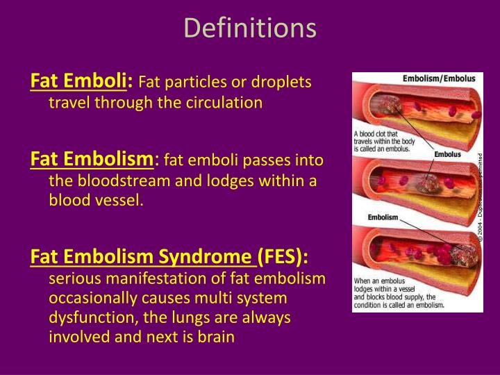PPT Fat Embolism Syndrome PowerPoint Presentation ID 1957326