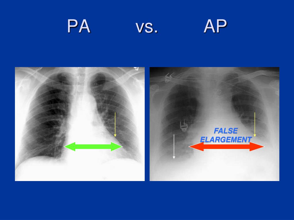 What Is The Difference Between A Pa And An Ap Chest X Ray At Natalie 