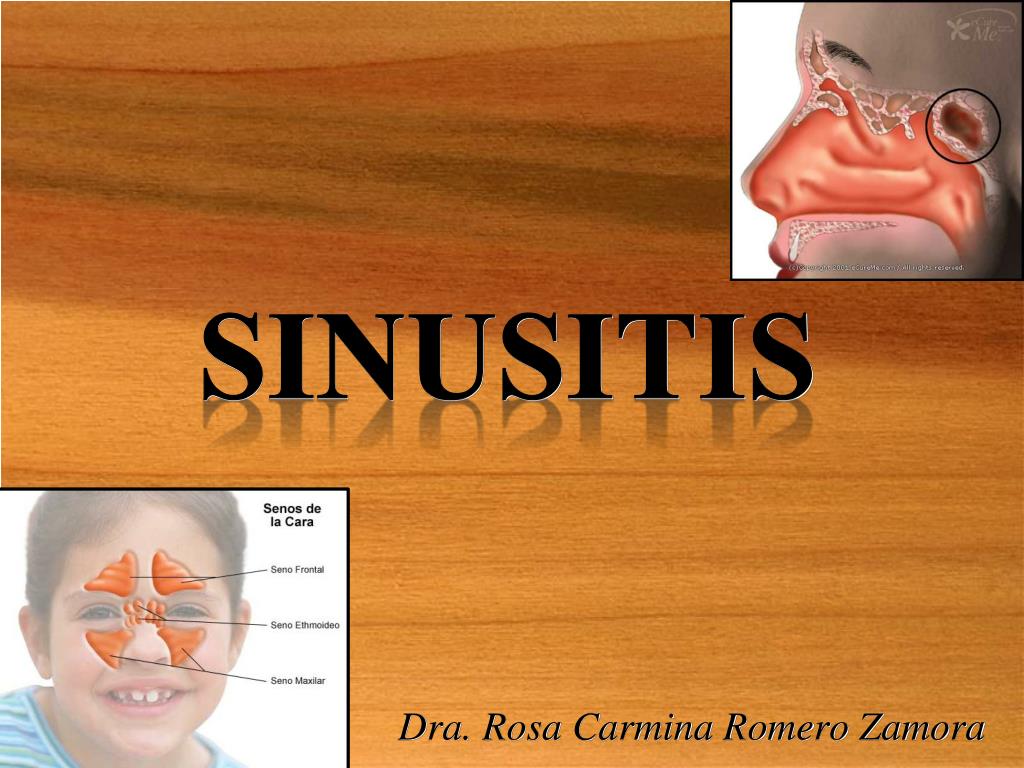 Sinusitis ppt 2024