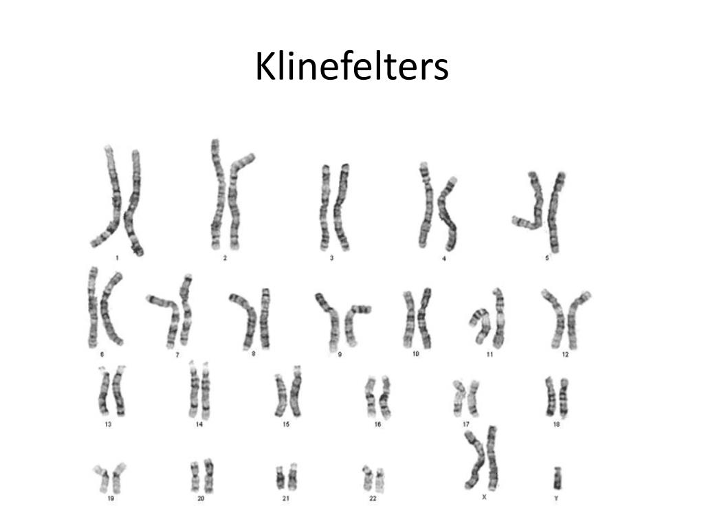 Xxy хромосома. Синдром Клайнфельтера схема. Синдром Клайнфельтера люди. Кариотип Клайнфельтера. Набор хромосом при синдроме Клайнфельтера.