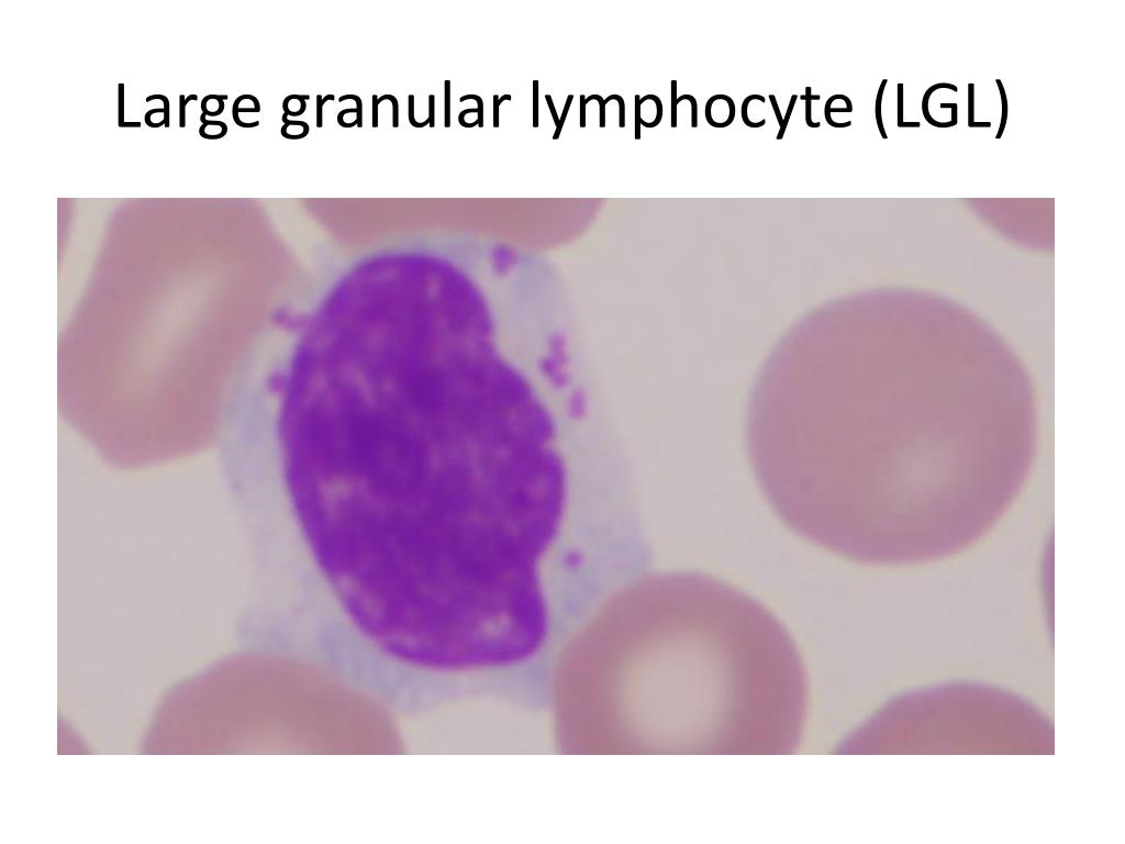Histopathology Images Of Large Granular Lymphocytic Lgl