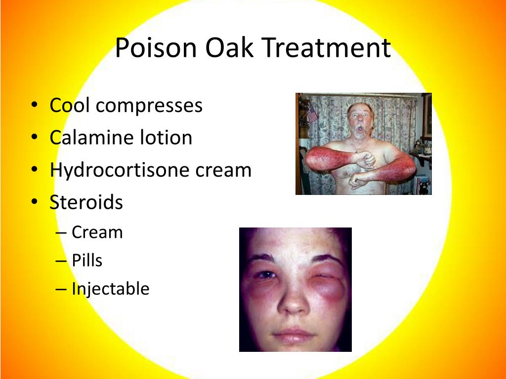 PPT Summer Skin Burns, Bites & Abrasions PowerPoint Presentation ID