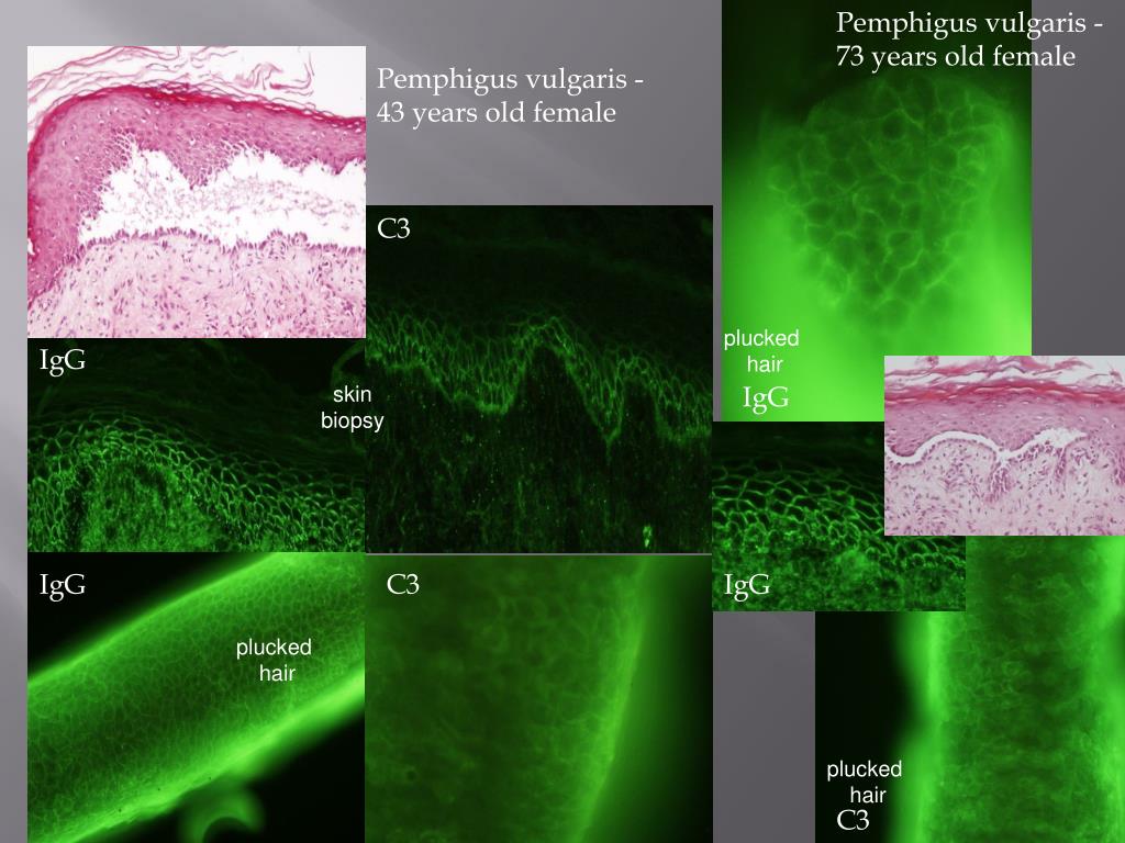 Ppt Direct Immunofluorescence On Plucked Hair In Immunological