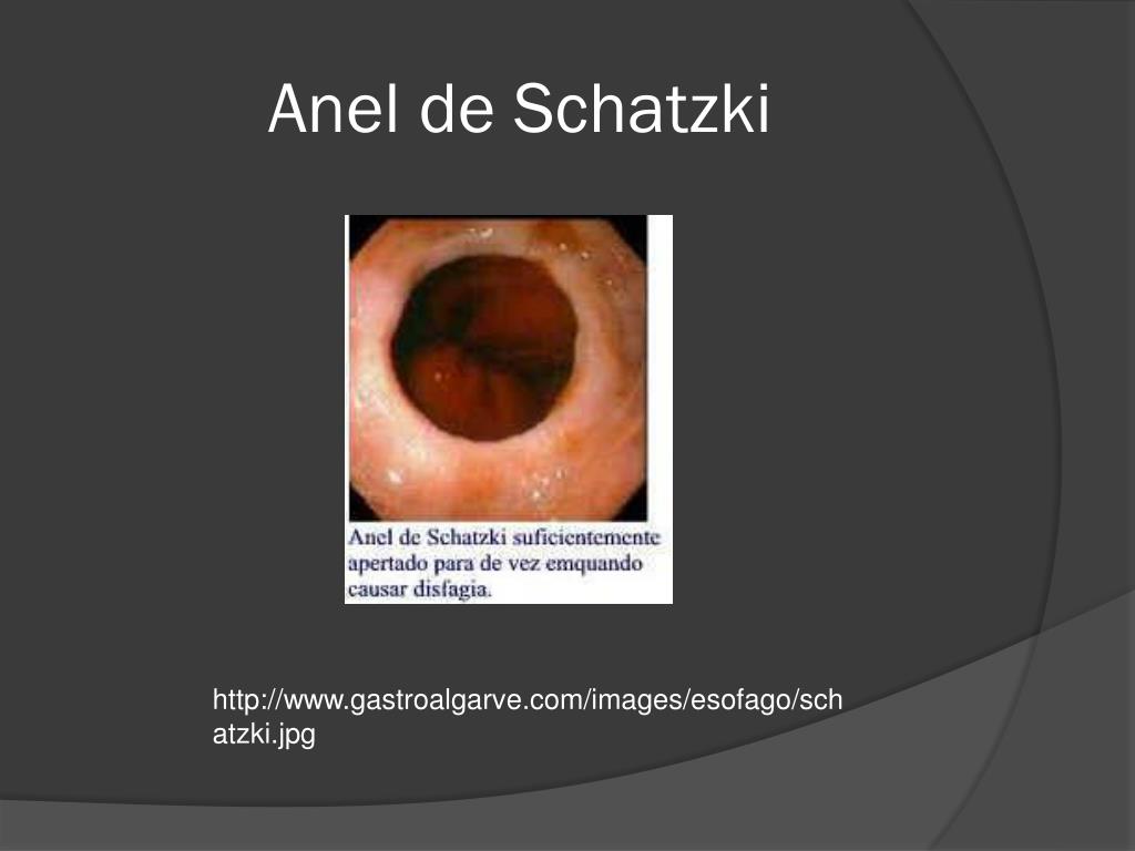 PPT - Patologias Benignas do Esôfago PowerPoint Presentation, free download  - ID:1995173