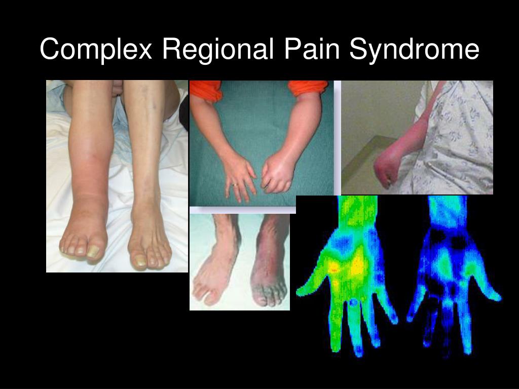 PPT The Brain in Pain Cortical contributions to Complex Regional Pain