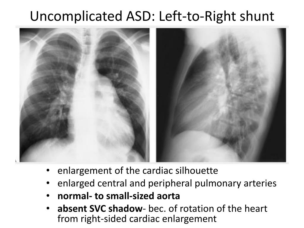 left right shunt vs dead space left right shunt vs dead space