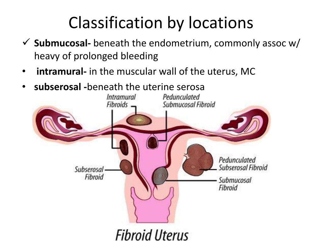 PPT Myoma Uteri OBGYN Rotation Quirino Memorial Medical Center