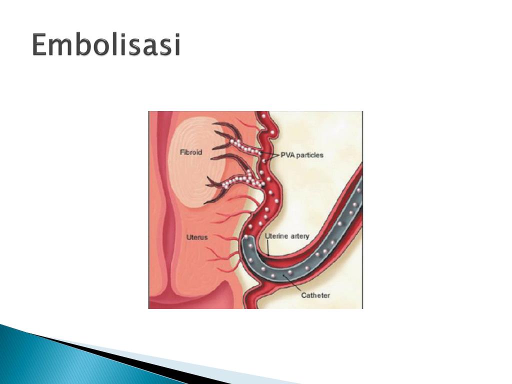 Embolisasi PPT - Tumor jinak ginekologi PowerPoint Presentation, free download ...