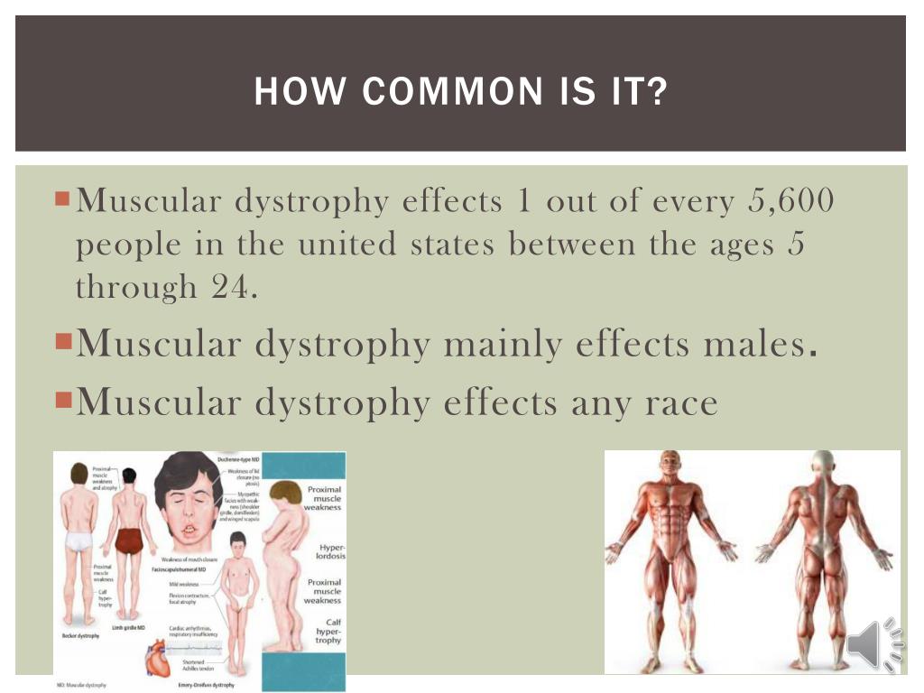 Muscular Dystrophy Types Chart