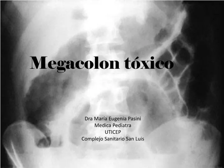 PPT Megacolon tóxico PowerPoint Presentation, free download ID2005191
