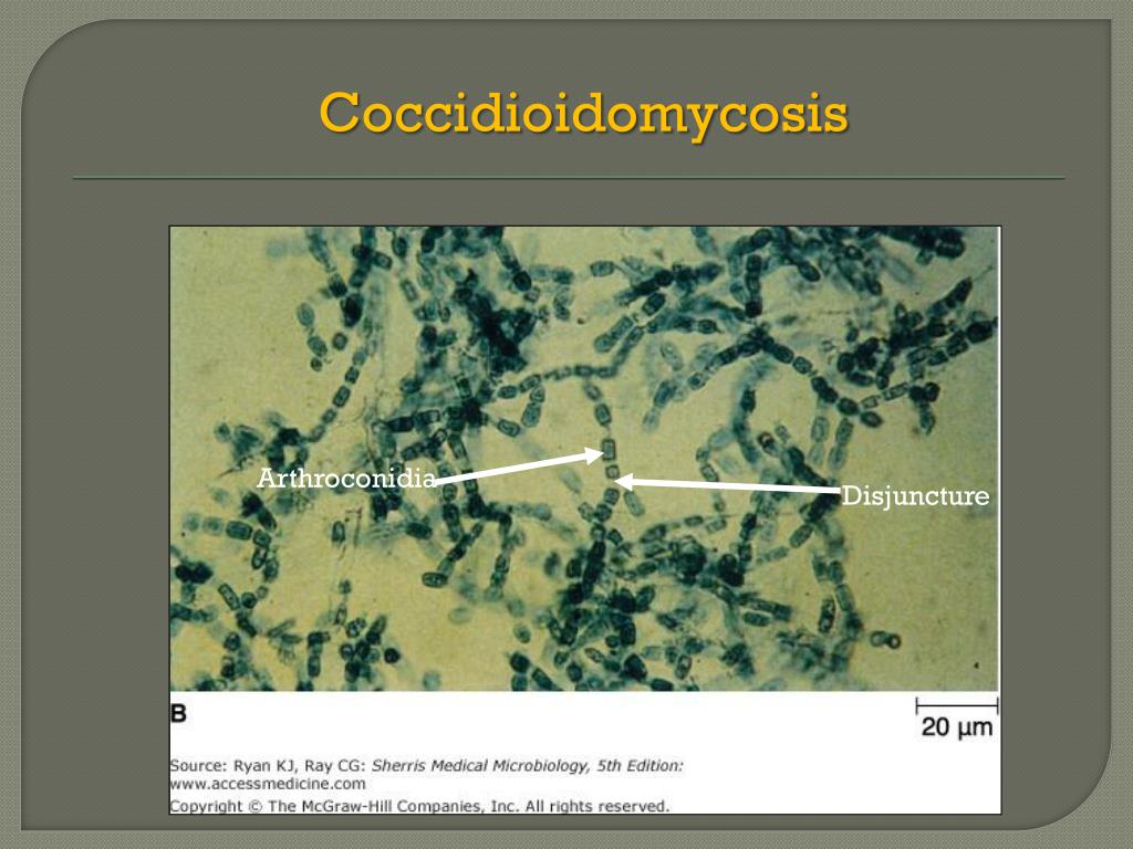 PPT - Disseminated Coccidioidomycosis PowerPoint Presentation, free ...