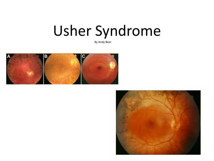 usher syndrome type 111 usher syndrome type 111