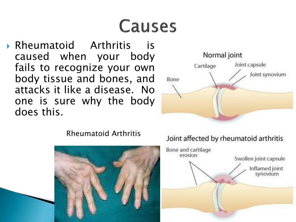 presentation of rheumatoid arthritis