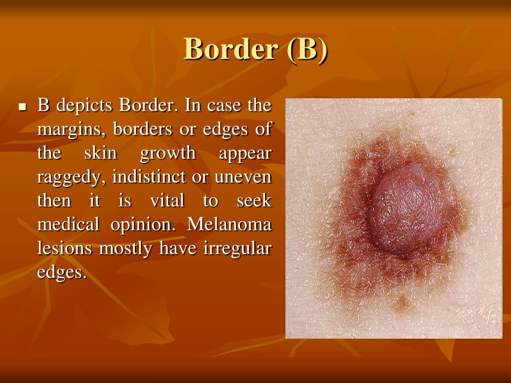 Defined Rash Border PPT - Being Wary About Five Signs of Skin Cancer PowerPoint ...