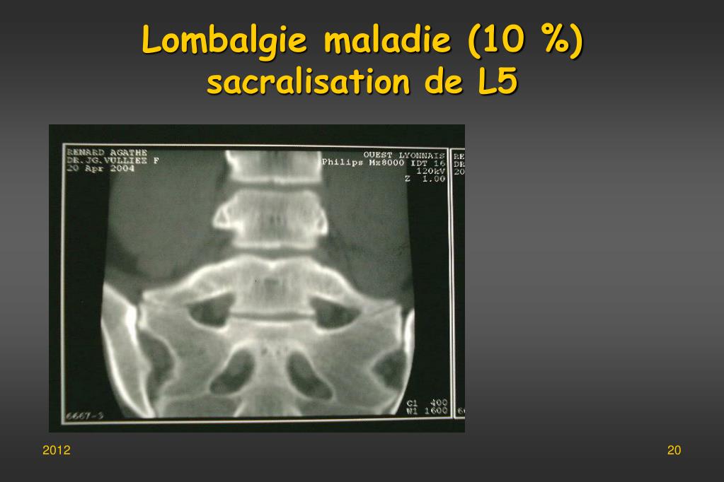 Anomalie Transitionnelle à Type De Sacralisation De L5 PPT - Jean Claude de MAUROY Bertrand Bordet PowerPoint Presentation