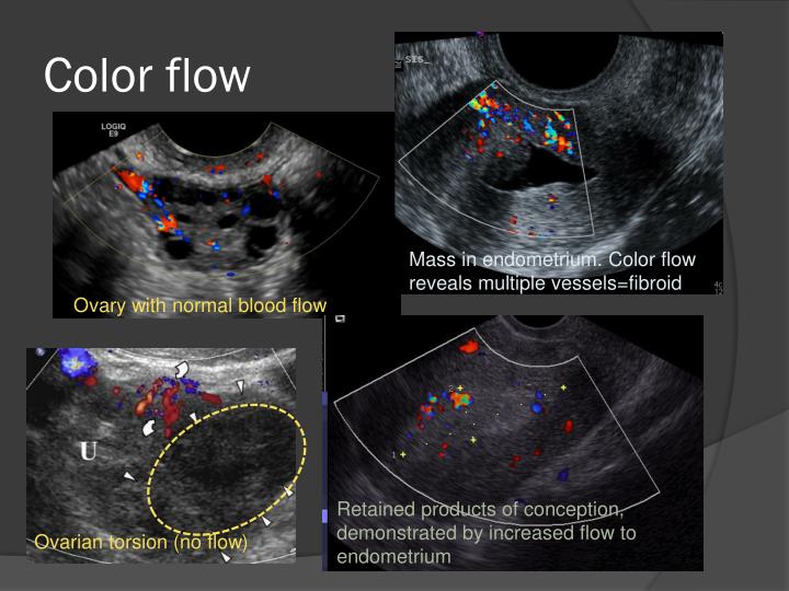 PPT Transvaginal ultrasound PowerPoint Presentation ID2022803