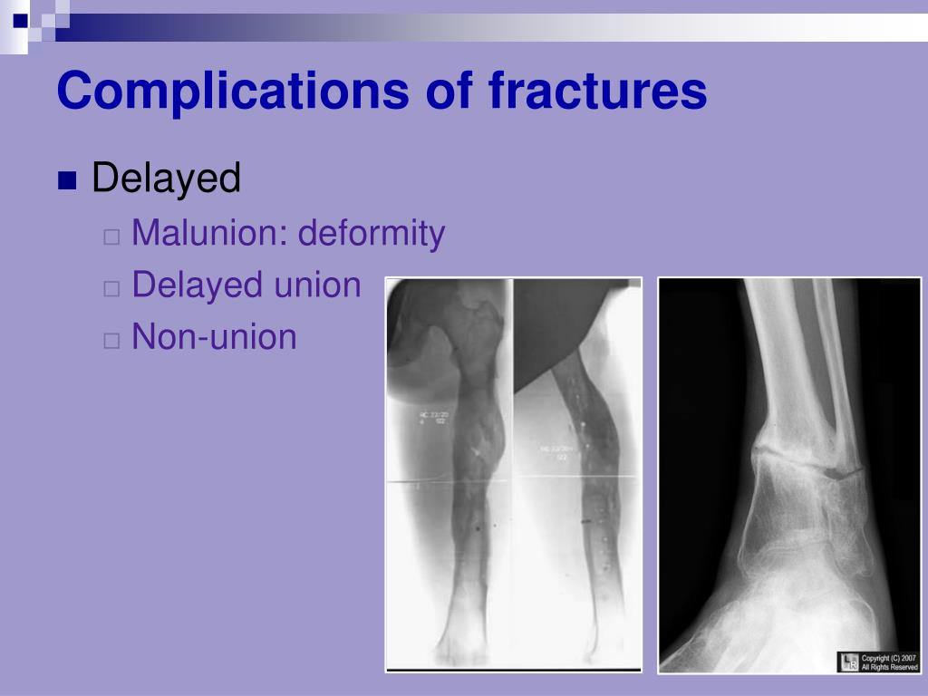 Ppt Bone Fracture And Healing Powerpoint Presentation Free Download