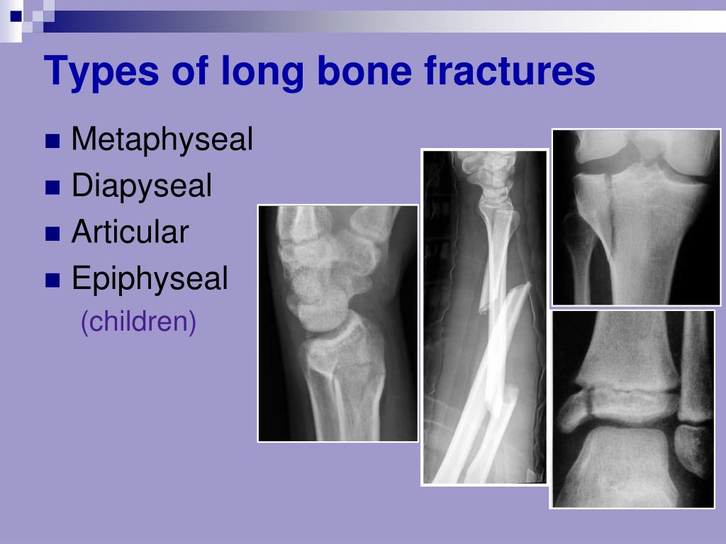 PPT - Bone Fracture and healing PowerPoint Presentation, free download