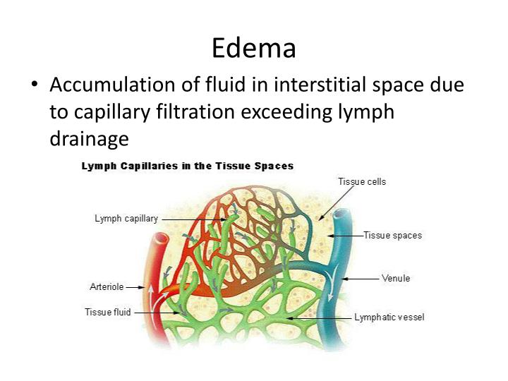 PPT - Edema PowerPoint Presentation - ID:2026887