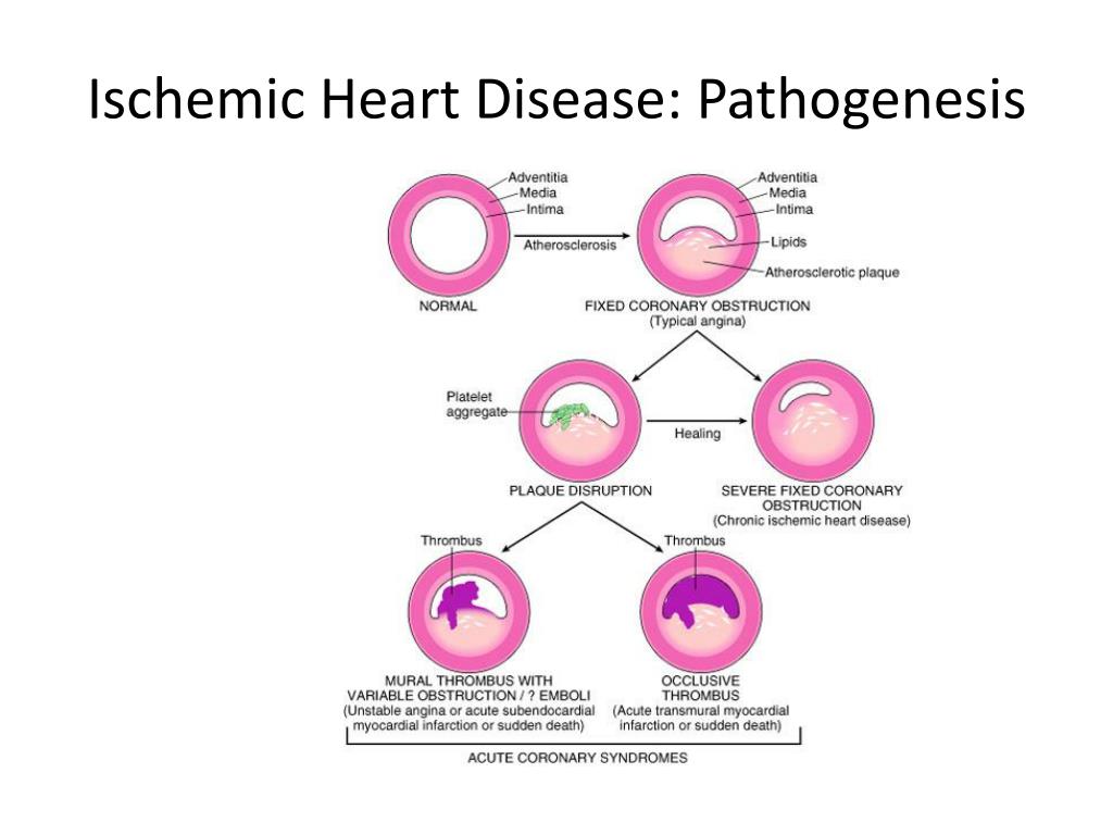 presentation of ischemic heart disease
