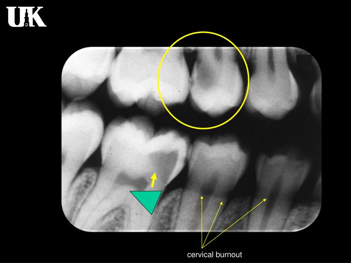 PPT Radiology of Caries PowerPoint Presentation ID2029144