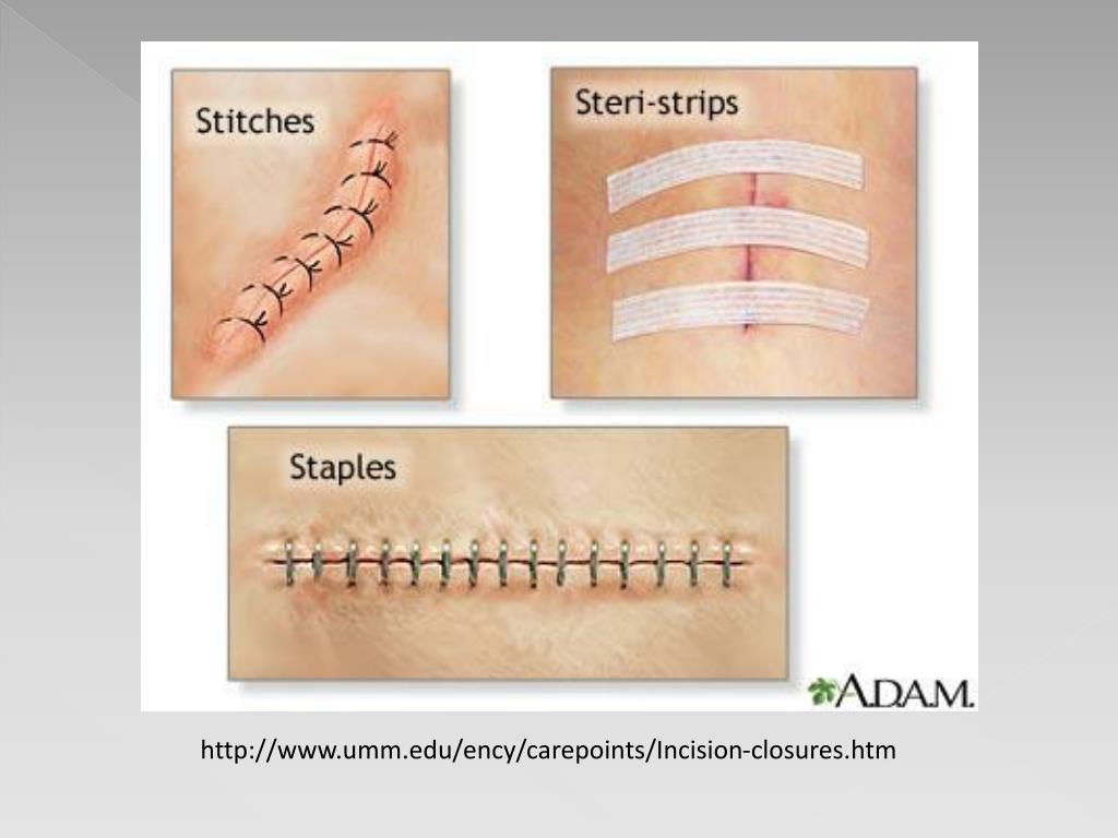 PPT Post Discharge Management Of Spinal Surgery Wounds PowerPoint 